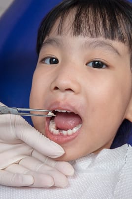 Pain-Free Tooth Extraction in Dublin, CA | We Care Dental | Dr. Chona Lardizabal Girl receiving gentle tooth extraction from Dr. Chona Lardizabal at We Care Dental in Dublin, CA. Smiling dental assistant Isaiah Orozco monitors comfort during the pain-free procedure in a modern, calming treatment room.