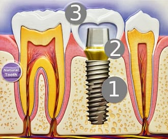 Dental Implant Components & How They Work | We Care Dental Dublin, CA Titanium dental implant post, abutment connector, and natural-looking crown for permanent tooth replacement at We Care Dental Dublin, CA