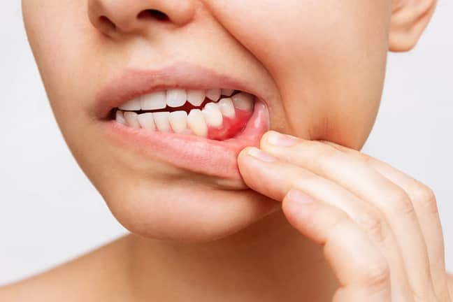 Stop Gum Disease Early | Deep Cleaning & Scaling in Dublin, CA Dr. Chona performing scaling and root planing to treat advanced gum disease at We Care Dental in Dublin, CA